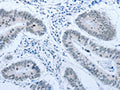 The image on the left is immunohistochemistry of paraffin-embedded Human colon cancer tissue using CSB-PA956054(ACIN1 Antibody) at dilution 1/30, on the right is treated with synthetic peptide. (Original magnification: X200)