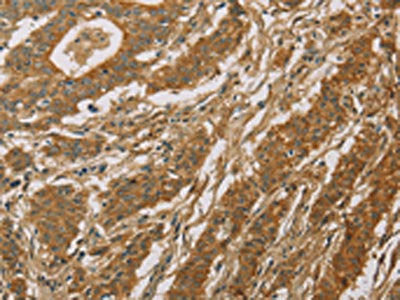 The image on the left is immunohistochemistry of paraffin-embedded Human gastic cancer tissue using CSB-PA956260(CYP39A1 Antibody) at dilution 1/50, on the right is treated with fusion protein. (Original magnification: ×200)