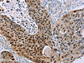 The image on the left is immunohistochemistry of paraffin-embedded Human esophagus cancer tissue using CSB-PA956333(MAGEA10 Antibody) at dilution 1/30, on the right is treated with fusion protein. (Original magnification: ×200)