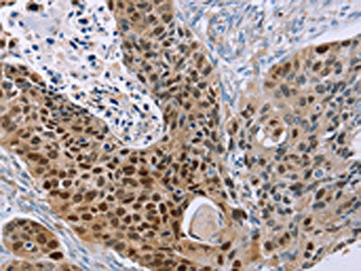 The image on the left is immunohistochemistry of paraffin-embedded Human esophagus cancer tissue using CSB-PA956333(MAGEA10 Antibody) at dilution 1/30, on the right is treated with fusion protein. (Original magnification: ×200)