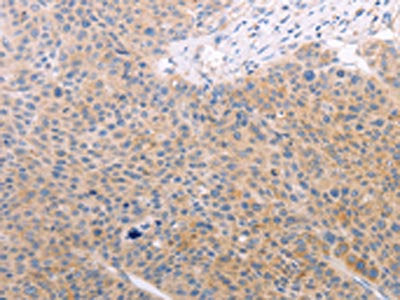 The image on the left is immunohistochemistry of paraffin-embedded Human liver cancer tissue using CSB-PA956427(SPATA16 Antibody) at dilution 1/40, on the right is treated with fusion protein. (Original magnification: ×200)