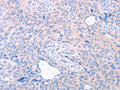 The image on the left is immunohistochemistry of paraffin-embedded Human cervical cancer tissue using CSB-PA956978(TRIM32 Antibody) at dilution 1/25, on the right is treated with fusion protein. (Original magnification: ×200)