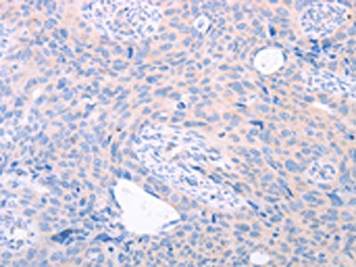 The image on the left is immunohistochemistry of paraffin-embedded Human cervical cancer tissue using CSB-PA956978(TRIM32 Antibody) at dilution 1/25, on the right is treated with fusion protein. (Original magnification: ×200)
