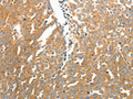 The image on the left is immunohistochemistry of paraffin-embedded Human ovarian cancer  tissue using CSB-PA957037(SOCS3 Antibody) at dilution 1/25, on the right is treated with fusion protein. (Original magnification: ×200)