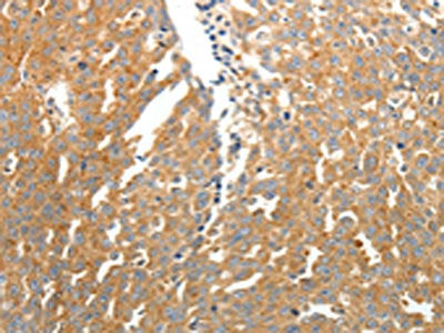 The image on the left is immunohistochemistry of paraffin-embedded Human ovarian cancer  tissue using CSB-PA957037(SOCS3 Antibody) at dilution 1/25, on the right is treated with fusion protein. (Original magnification: ×200)