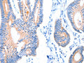 The image on the left is immunohistochemistry of paraffin-embedded Human colon cancer tissue using CSB-PA957686(ACADS Antibody) at dilution 1/20, on the right is treated with fusion protein. (Original magnification: ×200)