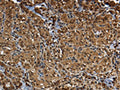 The image on the left is immunohistochemistry of paraffin-embedded Human thyroid cancer tissue using CSB-PA957737(GLO1 Antibody) at dilution 1/50, on the right is treated with fusion protein. (Original magnification: ×200)
