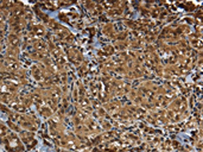 The image on the left is immunohistochemistry of paraffin-embedded Human thyroid cancer tissue using CSB-PA957737(GLO1 Antibody) at dilution 1/50, on the right is treated with fusion protein. (Original magnification: ×200)