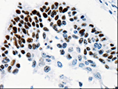 The image on the left is immunohistochemistry of paraffin-embedded Human cervical cancer tissue using CSB-PA957925(TGIF2LX Antibody) at dilution 1/25, on the right is treated with fusion protein. (Original magnification: ×200)