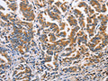 The image on the left is immunohistochemistry of paraffin-embedded Human gastic cancer tissue using CSB-PA958029(DOK4 Antibody) at dilution 1/60, on the right is treated with fusion protein. (Original magnification: ×200)