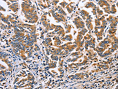 The image on the left is immunohistochemistry of paraffin-embedded Human gastic cancer tissue using CSB-PA958029(DOK4 Antibody) at dilution 1/60, on the right is treated with fusion protein. (Original magnification: ×200)