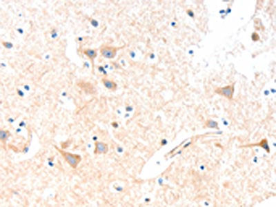 The image on the left is immunohistochemistry of paraffin-embedded Human brain tissue using CSB-PA958079(SLC19A2 Antibody) at dilution 1/15, on the right is treated with fusion protein. (Original magnification: ×200)