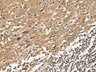 The image on the left is immunohistochemistry of paraffin-embedded Human esophagus cancer tissue using CSB-PA958339(ANGPTL7 Antibody) at dilution 1/40, on the right is treated with fusion protein. (Original magnification: ×200)