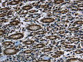 The image on the left is immunohistochemistry of paraffin-embedded Human gastic cancer tissue using CSB-PA958648(FTO Antibody) at dilution 1/60, on the right is treated with fusion protein. (Original magnification: ×200)