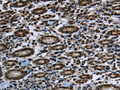 The image on the left is immunohistochemistry of paraffin-embedded Human gastic cancer tissue using CSB-PA958648(FTO Antibody) at dilution 1/60, on the right is treated with fusion protein. (Original magnification: ×200)