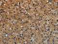 The image on the left is immunohistochemistry of paraffin-embedded Human liver cancer tissue using CSB-PA958657(TAB1 Antibody) at dilution 1/40, on the right is treated with fusion protein. (Original magnification: ×200)