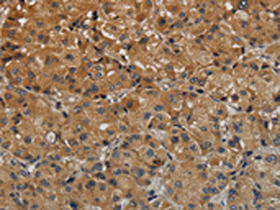 The image on the left is immunohistochemistry of paraffin-embedded Human liver cancer tissue using CSB-PA958657(TAB1 Antibody) at dilution 1/40, on the right is treated with fusion protein. (Original magnification: ×200)