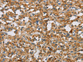 The image on the left is immunohistochemistry of paraffin-embedded Human thyroid cancer tissue using CSB-PA958803(DBH Antibody) at dilution 1/50, on the right is treated with fusion protein. (Original magnification: ×200)