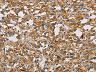 The image on the left is immunohistochemistry of paraffin-embedded Human thyroid cancer tissue using CSB-PA958803(DBH Antibody) at dilution 1/50, on the right is treated with fusion protein. (Original magnification: ×200)