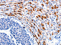 The image on the left is immunohistochemistry of paraffin-embedded Human liver cancer tissue using CSB-PA959008(CCNB1 Antibody) at dilution 1/20, on the right is treated with synthetic peptide. (Original magnification: ×200)
