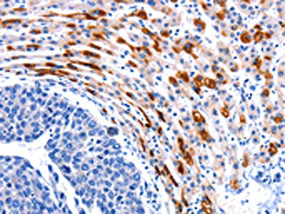 The image on the left is immunohistochemistry of paraffin-embedded Human liver cancer tissue using CSB-PA959008(CCNB1 Antibody) at dilution 1/20, on the right is treated with synthetic peptide. (Original magnification: ×200)