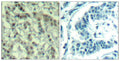 Immunohistochemical analysis of paraffin-embedded human breast carcinoma tissue using Aurora A(Phospho-Thr288) Antibody(left) or the same antibody preincubated with blocking peptide(right).