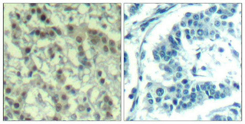 Immunohistochemical analysis of paraffin-embedded human breast carcinoma tissue using Aurora A(Phospho-Thr288) Antibody(left) or the same antibody preincubated with blocking peptide(right).