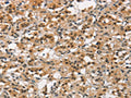The image on the left is immunohistochemistry of paraffin-embedded Human thyroid cancer tissue using CSB-PA959149(ANAPC4 Antibody) at dilution 1/30, on the right is treated with synthetic peptide. (Original magnification: ×200)
