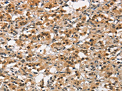 The image on the left is immunohistochemistry of paraffin-embedded Human thyroid cancer tissue using CSB-PA959149(ANAPC4 Antibody) at dilution 1/30, on the right is treated with synthetic peptide. (Original magnification: ×200)