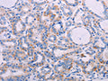 The image on the left is immunohistochemistry of paraffin-embedded Human thyroid cancer tissue using CSB-PA959270(AGT Antibody) at dilution 1/30, on the right is treated with synthetic peptide. (Original magnification: ×200)