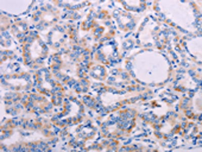 The image on the left is immunohistochemistry of paraffin-embedded Human thyroid cancer tissue using CSB-PA959270(AGT Antibody) at dilution 1/30, on the right is treated with synthetic peptide. (Original magnification: ×200)
