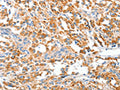 The image on the left is immunohistochemistry of paraffin-embedded Human thyroid cancer tissue using CSB-PA959352(CLIP1 Antibody) at dilution 1/20, on the right is treated with fusion protein. (Original magnification: ×200)