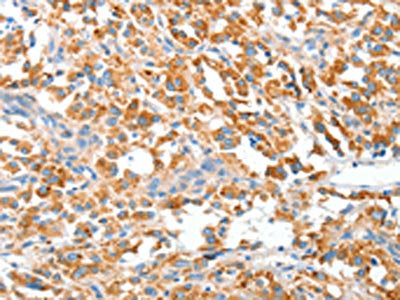 The image on the left is immunohistochemistry of paraffin-embedded Human thyroid cancer tissue using CSB-PA959352(CLIP1 Antibody) at dilution 1/20, on the right is treated with fusion protein. (Original magnification: ×200)
