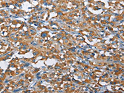 The image on the left is immunohistochemistry of paraffin-embedded Human thyroid cancer tissue using CSB-PA959499(KLF7 Antibody) at dilution 1/40, on the right is treated with fusion protein. (Original magnification: ×200)