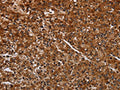 The image on the left is immunohistochemistry of paraffin-embedded Human prostate cancer tissue using CSB-PA959682(ACP6 Antibody) at dilution 1/30, on the right is treated with fusion protein. (Original magnification: ×200)