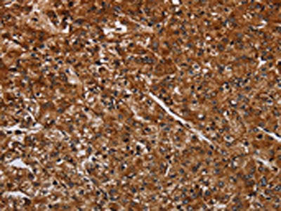 The image on the left is immunohistochemistry of paraffin-embedded Human prostate cancer tissue using CSB-PA959682(ACP6 Antibody) at dilution 1/30, on the right is treated with fusion protein. (Original magnification: ×200)