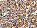 The image on the left is immunohistochemistry of paraffin-embedded Human tonsil tissue using CSB-PA959704(PPP1CB Antibody) at dilution 1/30, on the right is treated with fusion protein. (Original magnification: ×200)