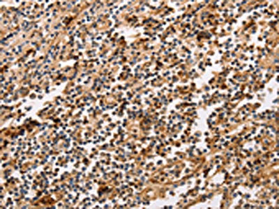 The image on the left is immunohistochemistry of paraffin-embedded Human tonsil tissue using CSB-PA959704(PPP1CB Antibody) at dilution 1/30, on the right is treated with fusion protein. (Original magnification: ×200)