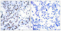 Immunohistochemical analysis of paraffin-embedded human breast carcinoma tissue using JunB(Ab-79) Antibody(left) or the same antibody preincubated with blocking peptide(right).