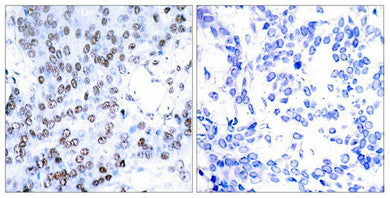 Immunohistochemical analysis of paraffin-embedded human breast carcinoma tissue using JunB(Ab-79) Antibody(left) or the same antibody preincubated with blocking peptide(right).