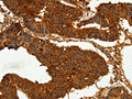 The image on the left is immunohistochemistry of paraffin-embedded Human colon cancer tissue using CSB-PA959823(CEACAM21 Antibody) at dilution 1/60, on the right is treated with fusion protein. (Original magnification: ×200)