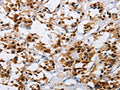 The image on the left is immunohistochemistry of paraffin-embedded Human thyroid cancer tissue using CSB-PA959846(IL17C Antibody) at dilution 1/50, on the right is treated with synthetic peptide. (Original magnification: X200)