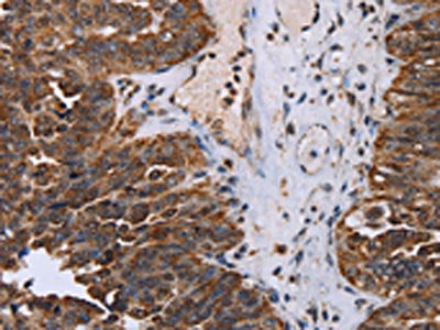 The image on the left is immunohistochemistry of paraffin-embedded Human ovarian cancer tissue using CSB-PA960020(DDX11 Antibody) at dilution 1/30, on the right is treated with fusion protein. (Original magnification: ×200)
