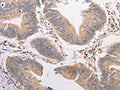 The image on the left is immunohistochemistry of paraffin-embedded Human colon cancer tissue using CSB-PA960186(PIP5K1A Antibody) at dilution 1/20, on the right is treated with fusion protein. (Original magnification: ×200)