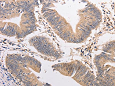 The image on the left is immunohistochemistry of paraffin-embedded Human colon cancer tissue using CSB-PA960186(PIP5K1A Antibody) at dilution 1/20, on the right is treated with fusion protein. (Original magnification: ×200)