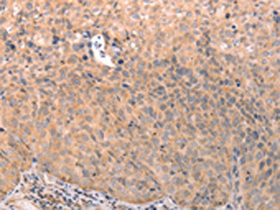 The image on the left is immunohistochemistry of paraffin-embedded Human cervical cancer tissue using CSB-PA960487(ABCF2 Antibody) at dilution 1/15, on the right is treated with fusion protein. (Original magnification: ×200)