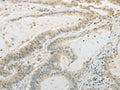 The image on the left is immunohistochemistry of paraffin-embedded Human colon cancer tissue using CSB-PA960570(PLAU Antibody) at dilution 1/10, on the right is treated with fusion protein. (Original magnification: ×200)