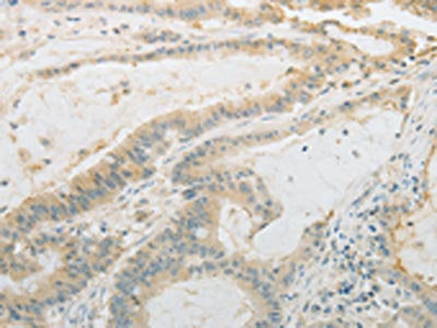 The image on the left is immunohistochemistry of paraffin-embedded Human colon cancer tissue using CSB-PA960570(PLAU Antibody) at dilution 1/10, on the right is treated with fusion protein. (Original magnification: ×200)