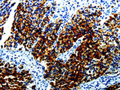 The image on the left is immunohistochemistry of paraffin-embedded Human renal cancer tissue using CSB-PA960585(AGR2 Antibody) at dilution 1/10, on the right is treated with fusion protein. (Original magnification: ×200)