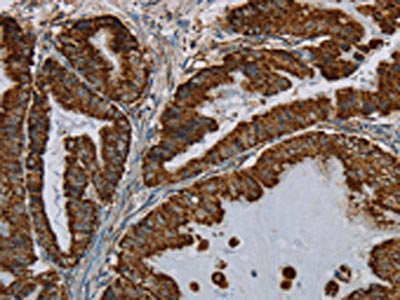 The image on the left is immunohistochemistry of paraffin-embedded Human esophagus cancer tissue using CSB-PA960706(HSD17B2 Antibody) at dilution 1/50, on the right is treated with fusion protein. (Original magnification: ×200)